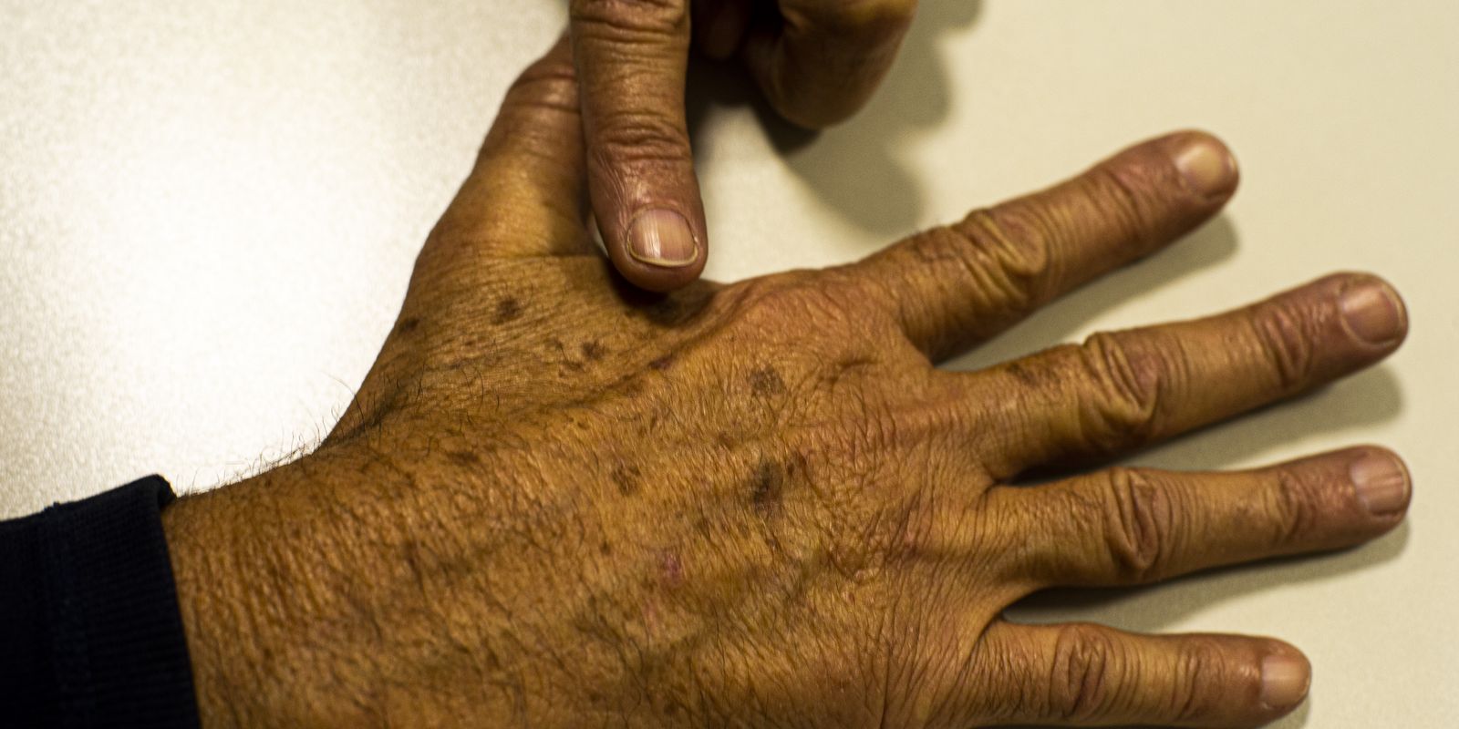 Falhas em dados sobre câncer de pele prejudicam diagnóstico e prevenção, alerta fundação
