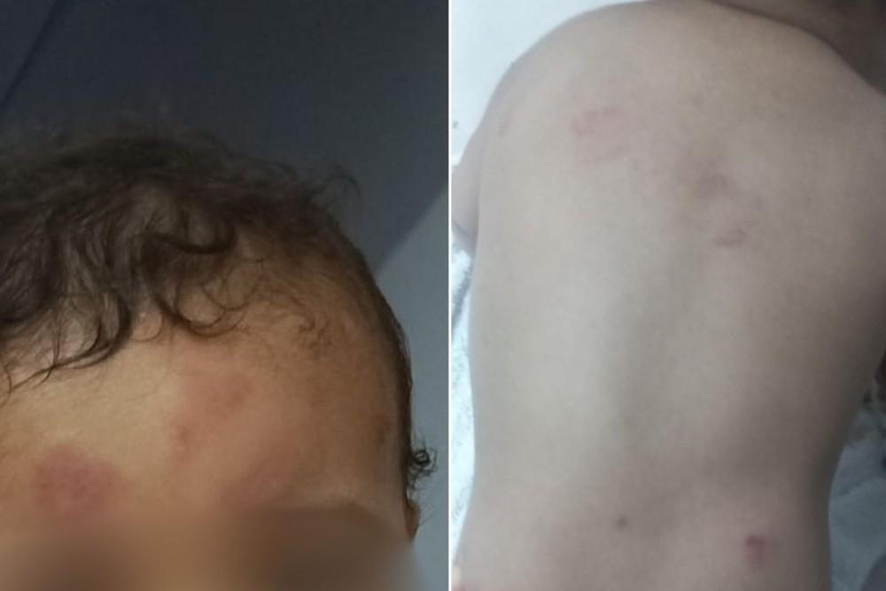 Bebê volta da creche com mordidas e hematomas e mãe acusa negligência em Guarujá