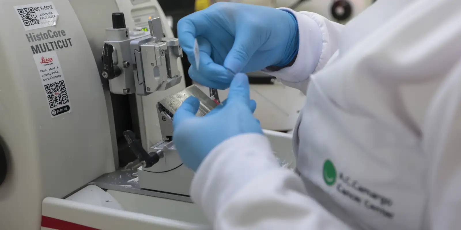 SUS incorpora terapia com venetoclax e azacitidina para leucemia mieloide aguda