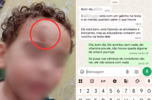 Mãe denuncia creche após menino de 2 anos aparecer com hematoma no rosto no litoral de SP