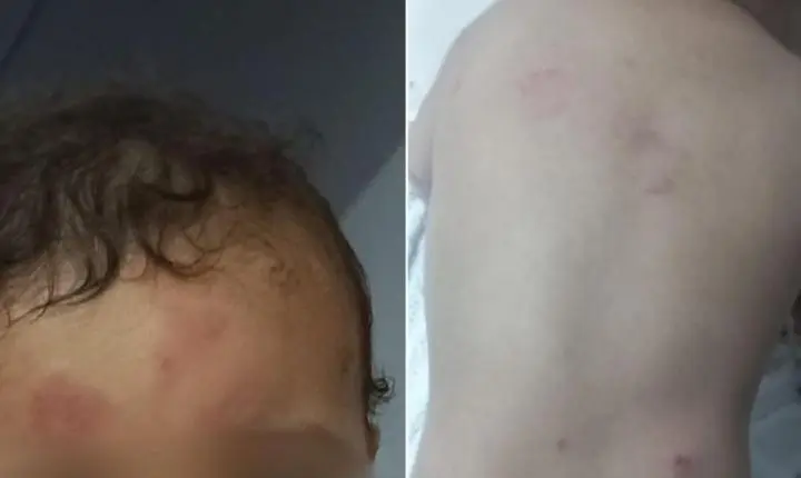 Bebê volta da creche com mordidas e hematomas e mãe acusa negligência em Guarujá