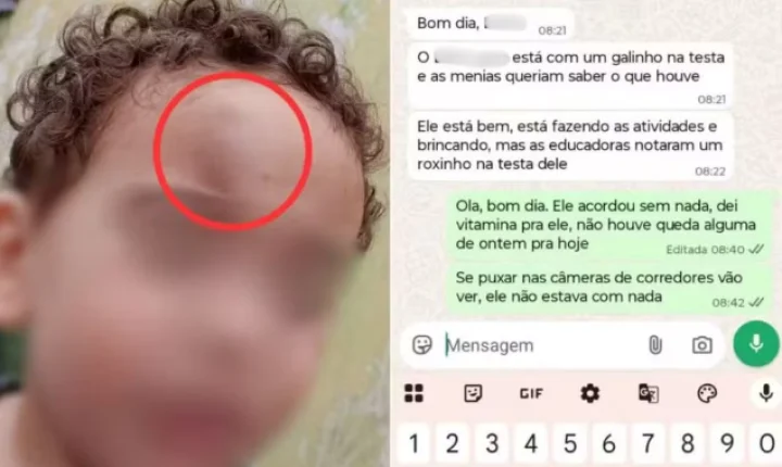 Mãe denuncia creche após menino de 2 anos aparecer com hematoma no rosto no litoral de SP